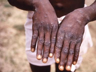 a-new-form-of-mpox-that-may-spread-more-easily-found-in-congo’s-biggest-outbreak