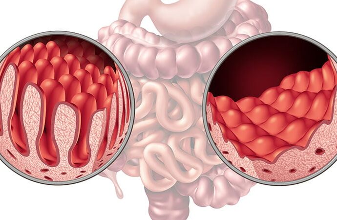 Sequential CE-DBE Approach Detects CD-Related Complications