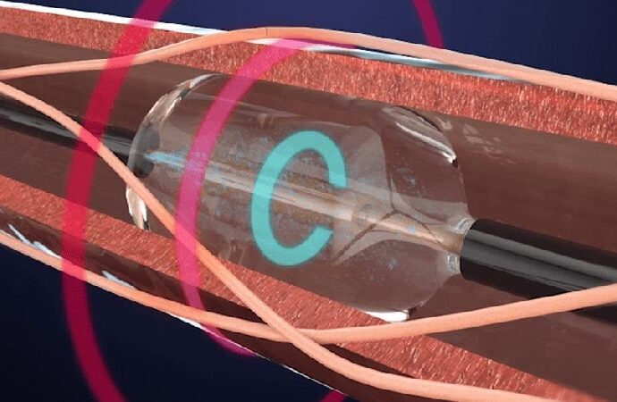 Nighttime & Early Morning BP Controlled by Renal Denervation