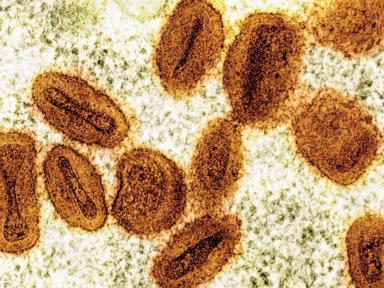 us-health-officials-report-1st-case-of-new-form-of-mpox-in-a-traveler