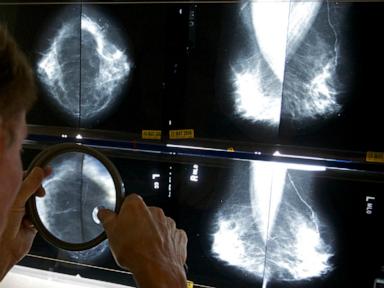 some-breast-cancer-patients-can-avoid-certain-surgeries,-studies-suggest