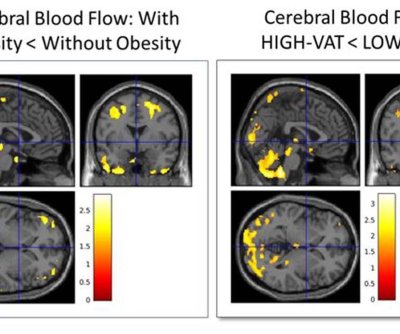 deep-belly-fat-could-predict-alzheimer’s-disease-decades-ahead-of-symptoms