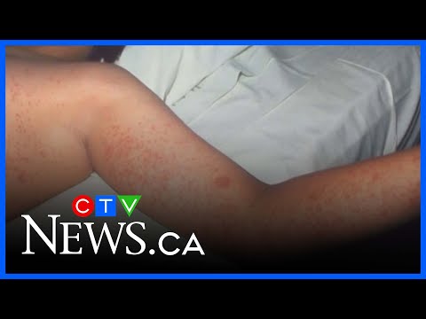 measles-exposure-in-the-sault-area