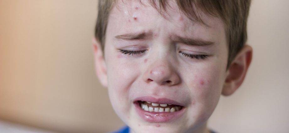 rfk-jr.’s-misleading-line-on-the-chickenpox-vaccine