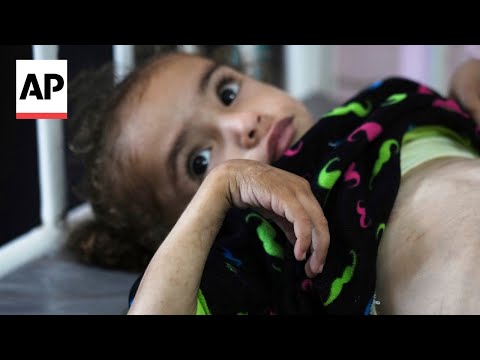 gaza’s-main-hospital-is-overwhelmed-with-children-in-pain-from-malnutrition