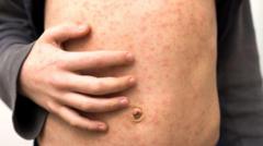 measles-holiday-warning-as-cases-rise-in-europe