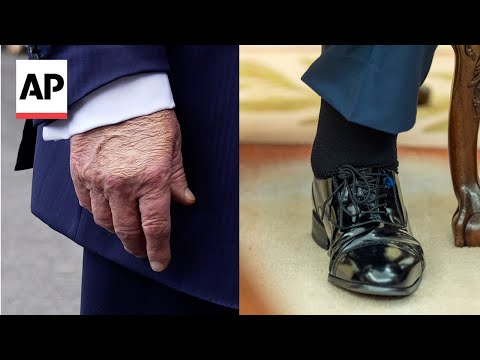 the-traitor-diagnosed-with-chronic-venous-insufficiency-after-swollen-legs,-bruised-hand