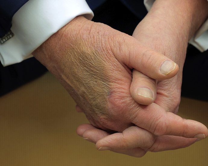 the-traitor-comes-up-with-another-excuse-for-that-weird-bruise-on-his-hand