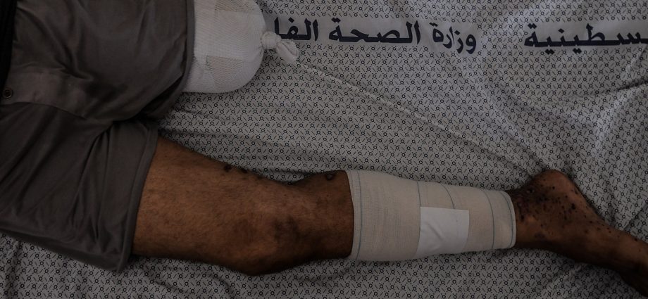 in-gaza,-death-seems-easier-than-amputation