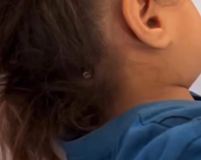gaza-child-in-hospital-with-israeli-bullet-protruding-from-her-skull