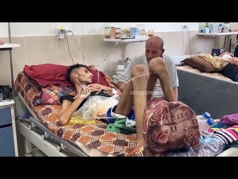 doctors-in-gaza-say-evidence-of-malnutrition-is-right-in-front-of-them