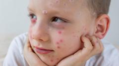 what-is-chickenpox-and-how-can-i-get-my-child-vaccinated?