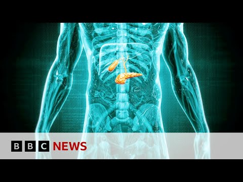 detecting-‘hidden’-pancreatic-cancer-cases-|-bbc-news