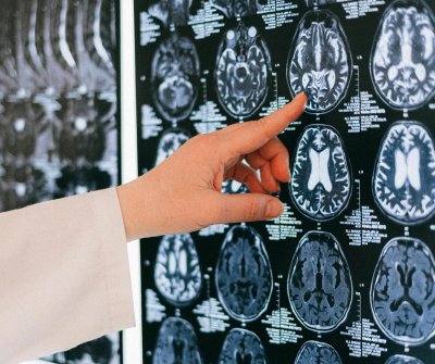 brain-biomarker-that-could-allow-early-alzheimer’s-detection-found