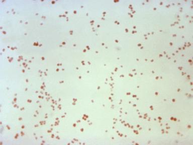 sexually-transmitted-disease-cases-fall,-but-not-syphilis-in-newborns