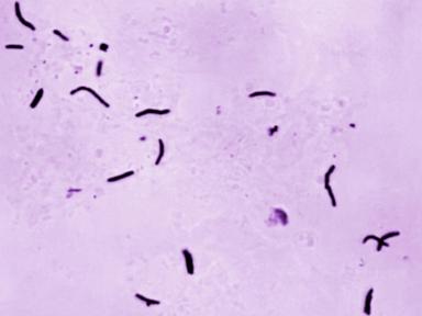 global-tuberculosis-diagnoses-rise-to-a-record,-but-deaths-fall,-who-reports