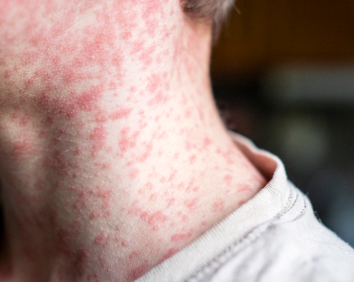 US could lose its measles elimination status within months, experts say