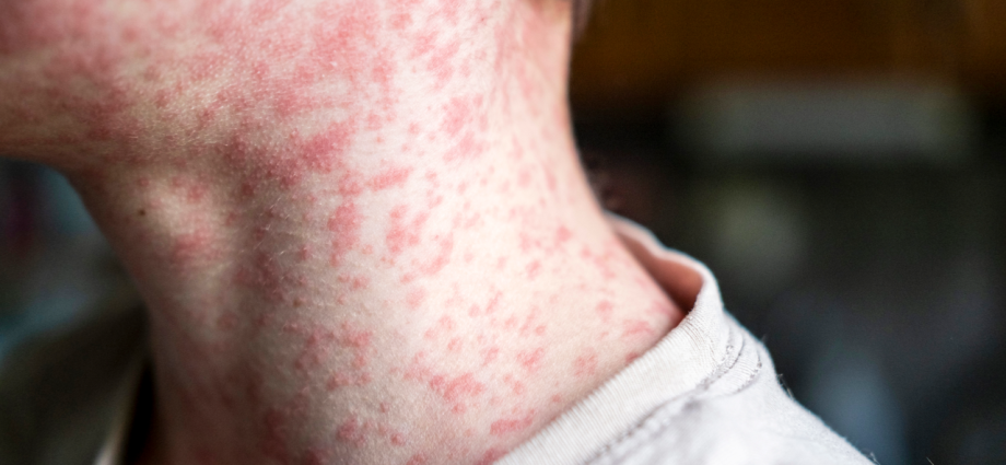 US could lose its measles elimination status within months, experts say