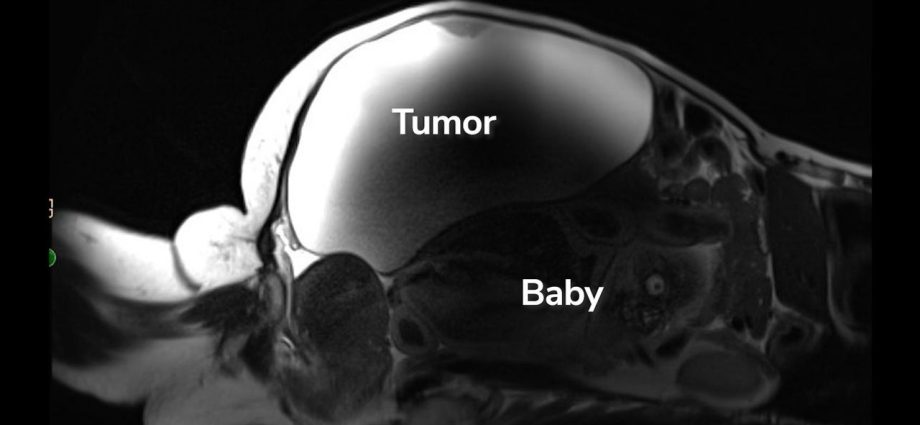 ‘Unprecedented’: Woman delivers full-term abdominal pregnancy while also having 22-pound cyst removed
