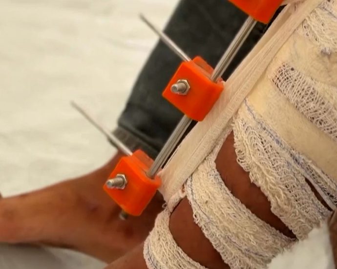 gaza-doctors-create-3d-printed-devices-to-save-patients-from-amputation