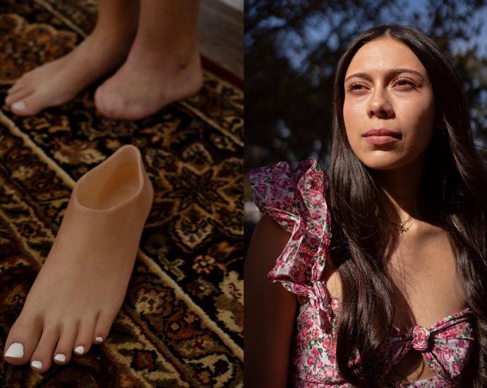 a-college-student-fights-an-insurance-denial-to-get-a-prosthetic-foot-before-graduation