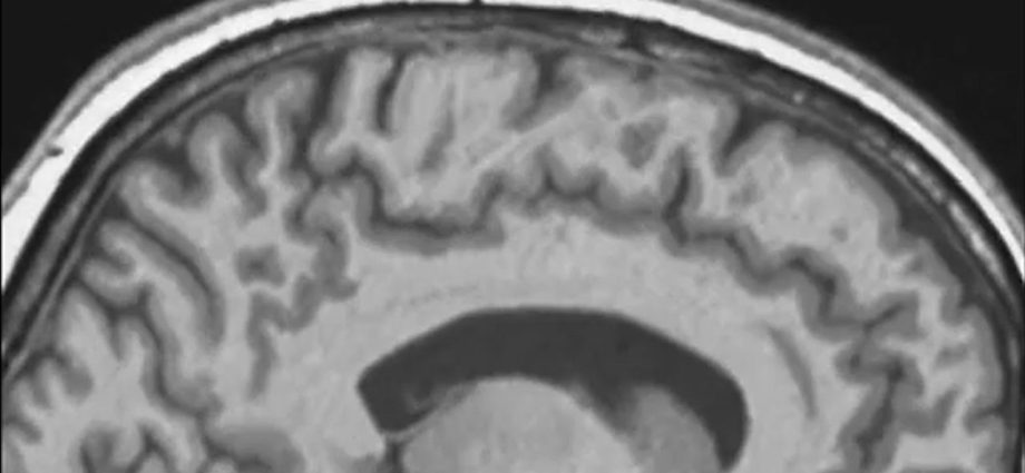 ‘Backward and upward and tilted’: Spaceflight causes astronauts’ brains to shift inside their skulls