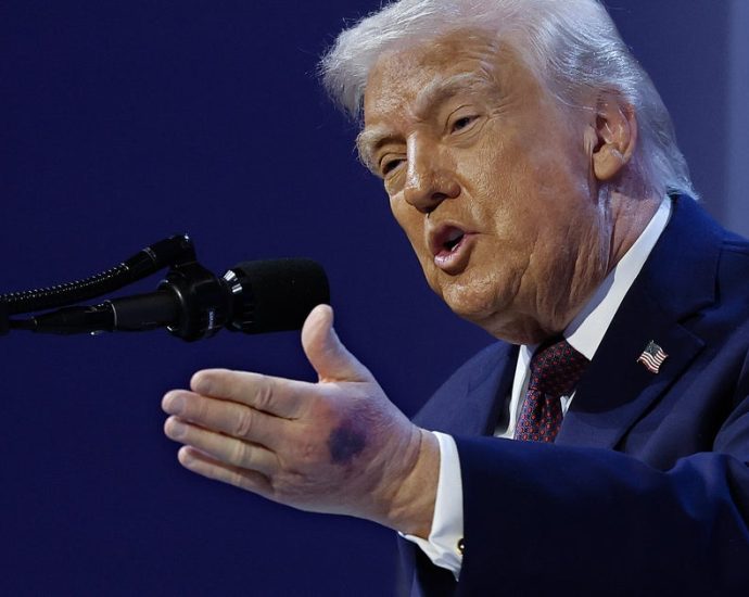 traitor-47-has-yet-another-hand-bruise-—-and-a-sketchy-excuse