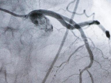 experimental-cholesterol-lowering-pill-may-offer-new-option-for-millions