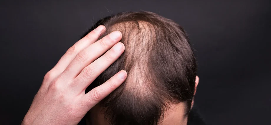 textbooks-were-wrong:-scientists-reveal-the-surprising-way-human-hair-really-grows