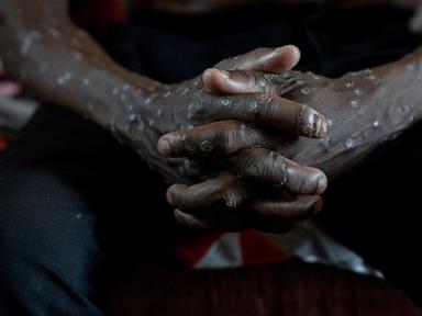 congo-says-its-mpox-outbreak-is-over-after-2-years-and-more-than-2,200-suspected-deaths