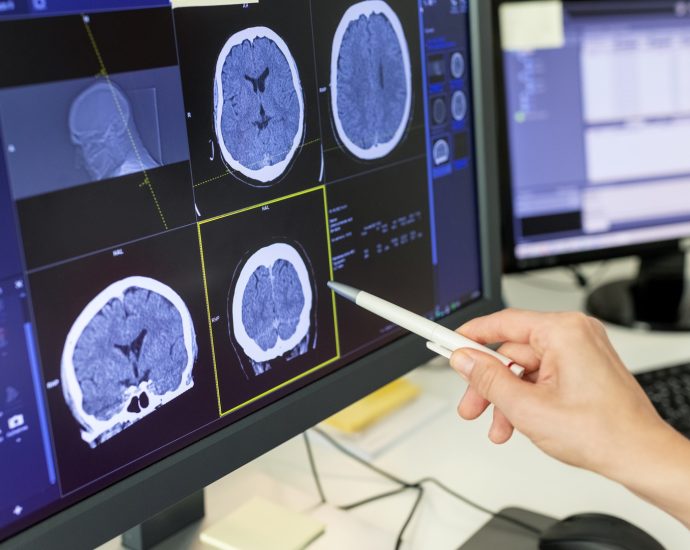 how-smart-choices-and-quicker-response-can-outsmart-stroke