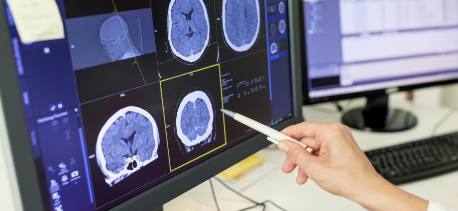 how-smart-choices-and-quicker-response-can-outsmart-stroke