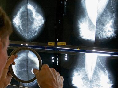 when-should-you-get-a-mammogram?-conflicting-advice-makes-it-hard-to-know