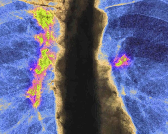 one-label,-many-risks:-how-grouping-asian-americans-hides-deadly-cancer-patterns