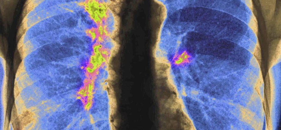 one-label,-many-risks:-how-grouping-asian-americans-hides-deadly-cancer-patterns