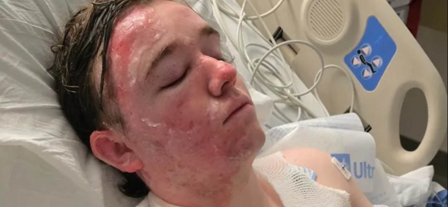mcdonald’s-worker-suffers-severe-burns-after-coworker-throws-hot-oil-on-him