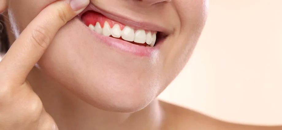 this-giant-tropical-fruit-could-help-reverse-gum-disease-damage