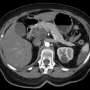 New targeted therapy shows promising early results in advanced pancreatic cancer