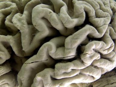 study-shows-blood-test-can-help-identify-people-at-high-risk-for-alzheimer’s-disease