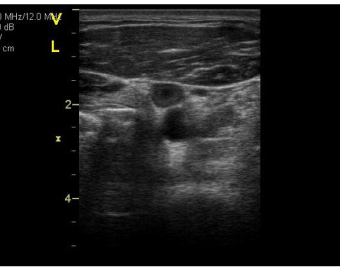 establishing-a-vte-risk-score-for-astronauts-algorithm