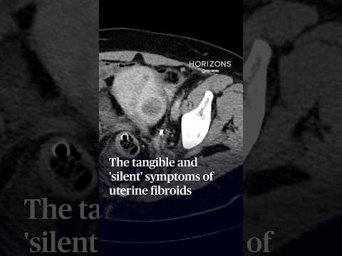 the-tangible-and-‘silent’-symptoms-of-uterine-fibroids