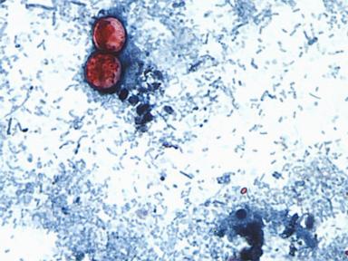 15-states-now-linked-to-iceberg-lettuce-cyclospora-outbreak,-cdc-says