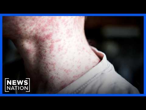 measles-cases-reach-highest-level-in-us.-since-1991